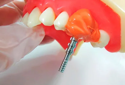 dental implant material