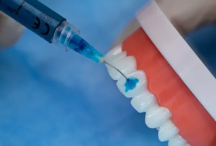 HUGE 37% Phosphoric Acid Etching Gel